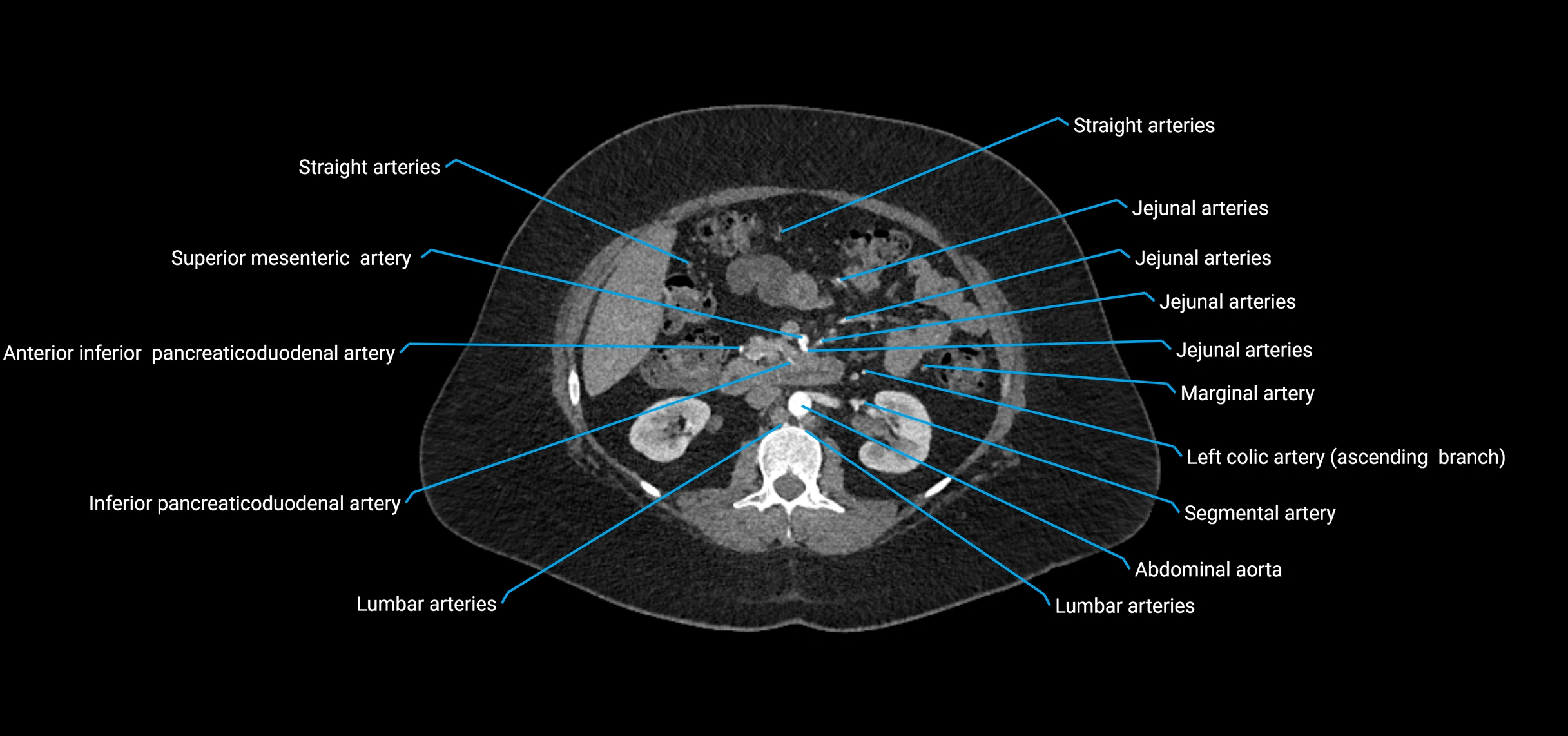 CTA abdomen axial cross sectional anatomy labelled image_79 (2).webp